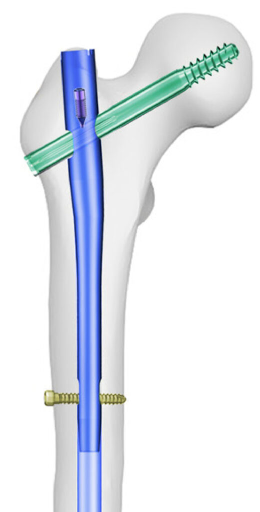 CLAVOS ENDOMEDULARES - vista 2